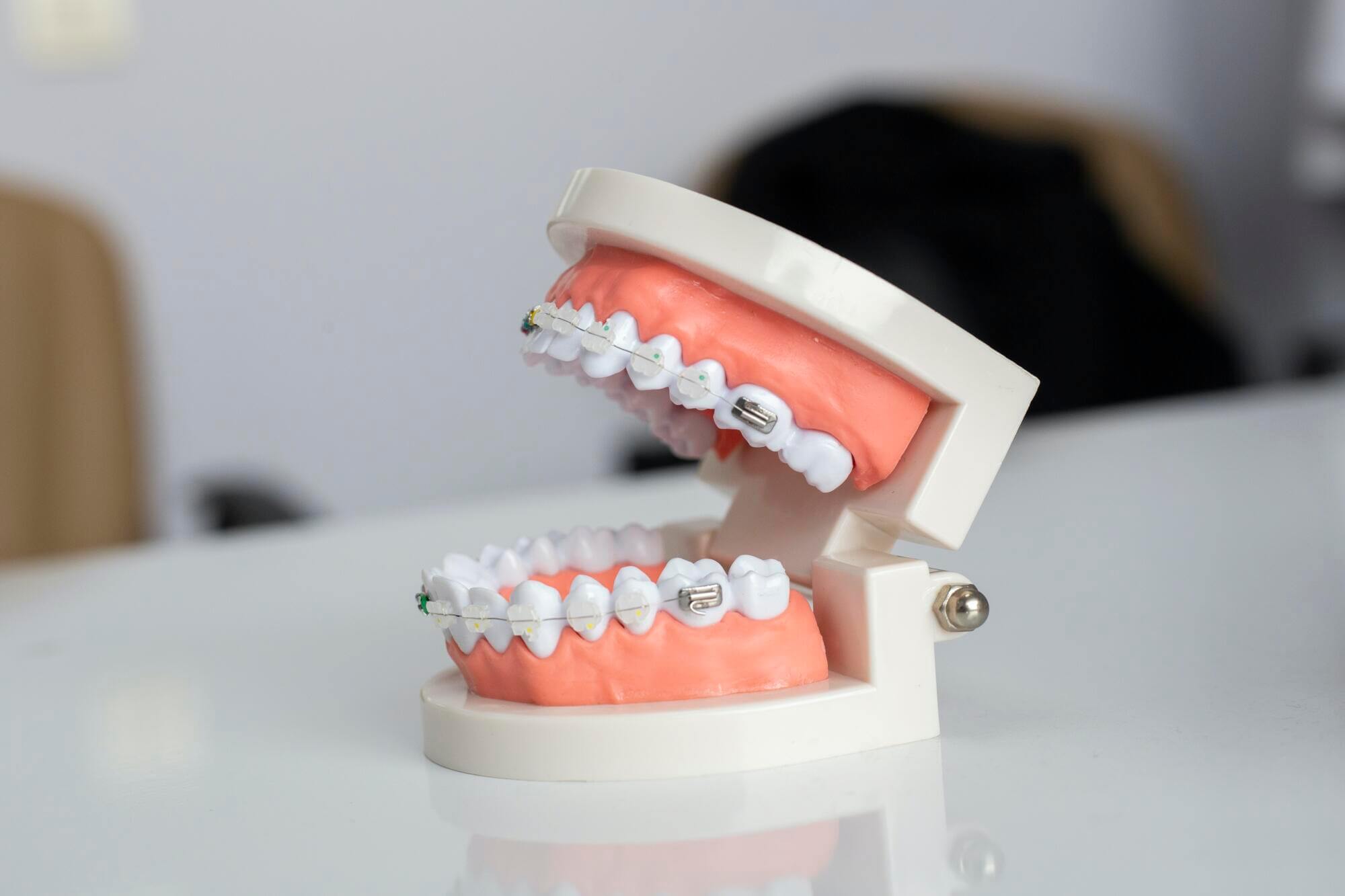 The Benefits of Choosing Damon Ceramic Braces